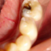 Pulpectomy – Root Canal Treatment of Milk Teeth