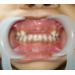 Replacement of Missing milk teeth