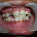 Mobile teeth - splinting