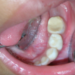 Pulpectomy – Root Canal Treatment of Milk Teeth