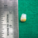 Tooth present at birth - natal teeth