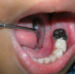 Root canal treatment of milk teeth