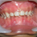 Pulpectomy – Root Canal Treatment of Milk Teeth (2)